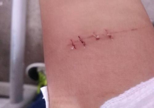 拆线后多久可以运动 腿上缝针拆线后多久可以运动