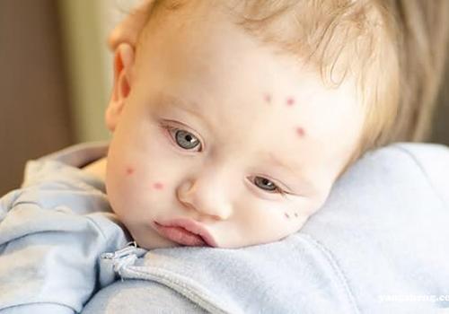 宝宝被蚊子咬可以涂牙膏吗 宝宝被蚊虫叮咬可以涂牙膏吗