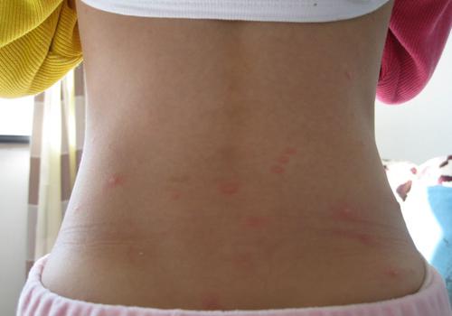 水痘潜伏期会传染吗 水痘潜伏期会传染吗 水痘的传染力