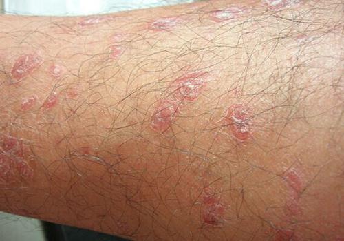 牛皮癣会传染吗 皮肤癣会传染给别人吗