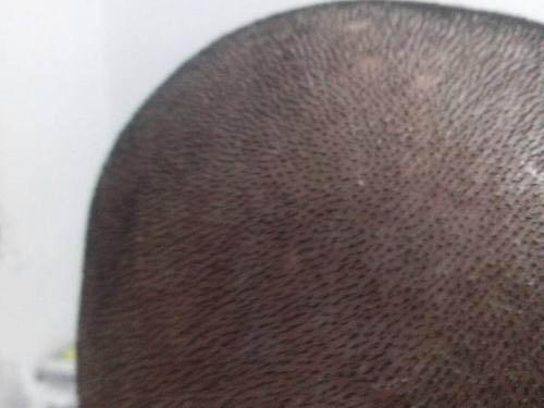 毛囊炎注意什么饮食（毛囊炎的饮食）