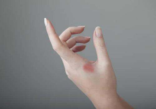 夏天烫伤要包扎吗 夏天烫伤怎么处理