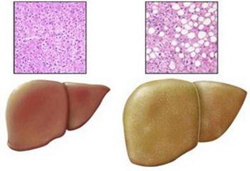 脂肪肝的危害及防治(脂肪肝有什么危害怎么治疗)