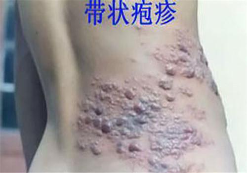 带状疱疹可以根治吗 带状疱疹怎么能根治