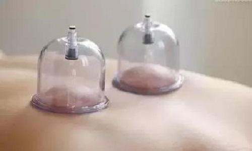 失眠拔罐在什么部位 失眠拔罐在什么部位图视频