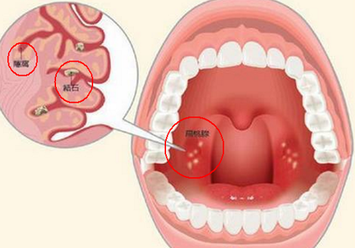 口里吐出颗粒很臭（嘴里吐出臭臭的颗粒）