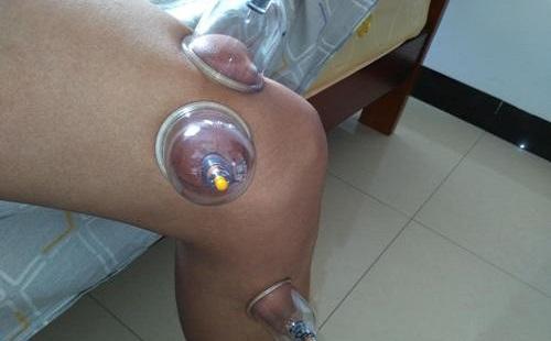 膝盖拔罐具体位置图 膝盖拔罐位置图解