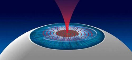 近视眼激光手术后遗症（近视眼激光手术后遗症概率）