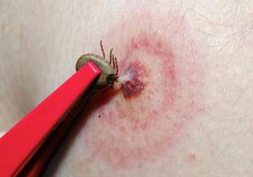 阴囊湿疹表皮有小白点是什么原因(阴囊湿疹处发白正常吗)