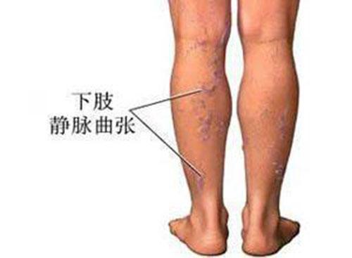 静脉曲张怎么缓解（静脉曲张怎么缓解,有哪些需要注意）