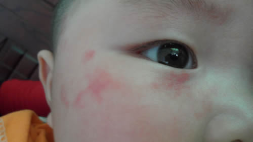 宝宝有胎毒吗 宝宝有胎毒有什么症状