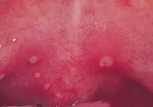 疱疹性咽峡炎有潜伏期吗（疱疹性咽峡炎有潜伏期吗,几天能自愈）