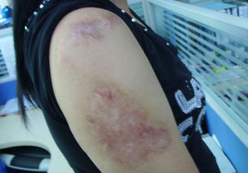 烫伤的疤能去掉吗（烫伤的疤能去掉吗贴吧）