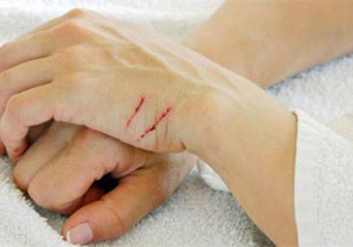 拆线出血正常吗