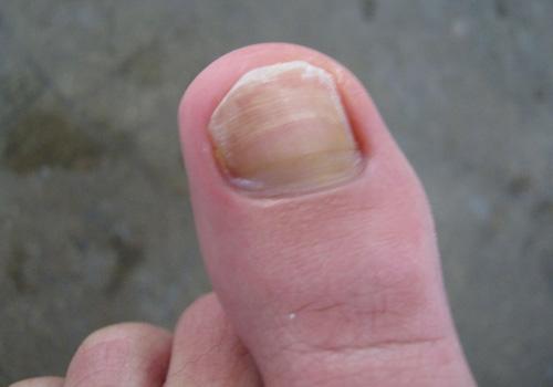 灰指甲如何传染给别人 灰指甲怎么才会传染给别人