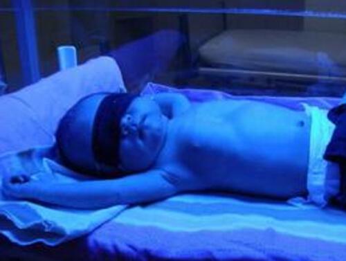 新生儿黄疸照蓝光有副作用吗 新婴儿黄疸照蓝光有副作用吗