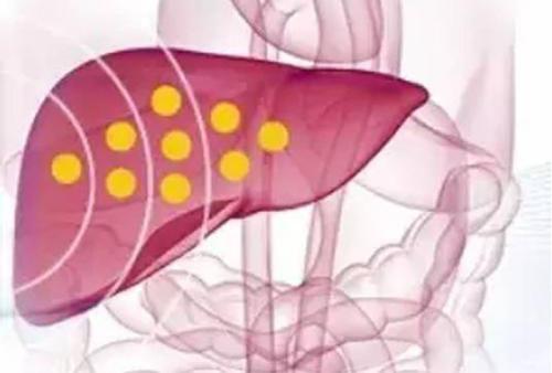 脂肪肝饮食注意什么（重度脂肪肝饮食注意什么）