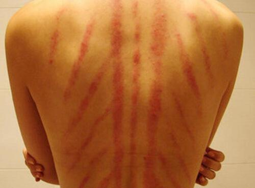 刮痧减肥有副作用吗 刮痧减肥有副作用吗吗