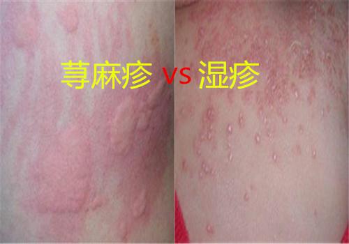 荨麻疹与湿疹的区别是什么（湿疹和荨麻疹什么区别）