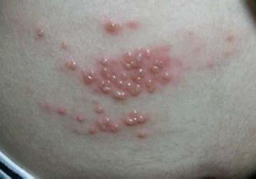 得了湿疹能晒太阳吗 湿疹能太阳晒吗?