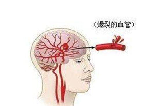 脑出血是怎么引起的（急性脑出血是怎么引起的）