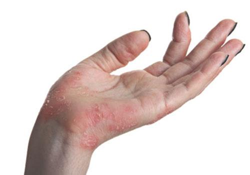 得湿疹吃中药还是西药(湿疹吃中药好还是西药)