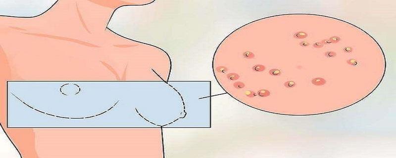 乳腺癌是一种什么样的病 乳腺癌是个什么病