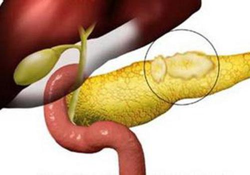 急性胰腺炎和慢性胰腺炎的区别（急性胰腺炎和慢性胰腺炎的区别 淀粉酶）