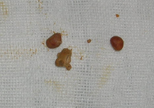 肾结石是怎么形成的 肾结石是怎么形成的,怎样才能消除