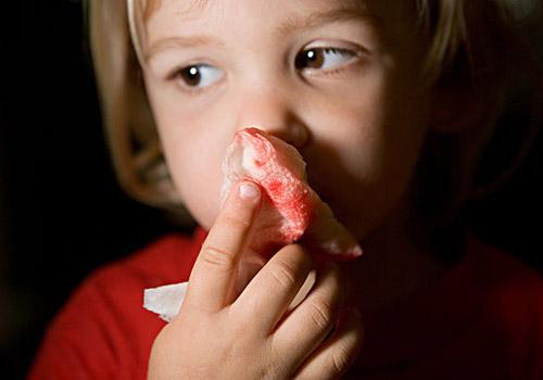 宝宝总是流鼻血怎么回事 最近宝宝总是流鼻血是怎么回事