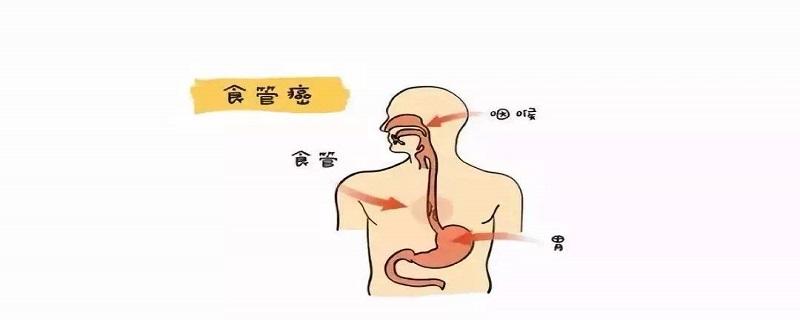 食道癌怎么检查出来的 食道癌是怎样检查出来的