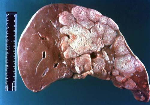 肝癌切除术后注意事项(肝脏肿瘤切除术后注意事项)