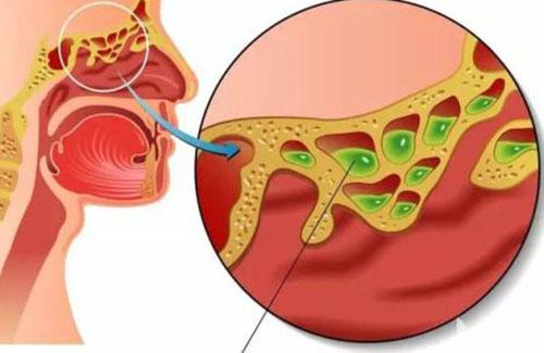 鼻窦炎有哪些症状 鼻窦炎有哪些症状反应