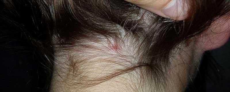 跳蚤会不会跳到人的头发里面去（跳蚤会到头发里去吗）