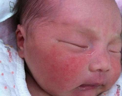 新生儿脸上长小红点怎么办 新生婴儿脸上长小红点怎么办