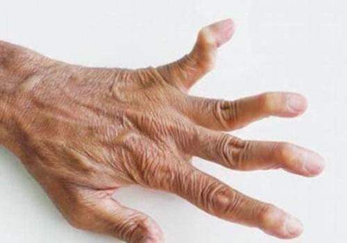 类风湿关节炎有哪些症状（类风湿关节炎有哪些症状会引起哪些病变）