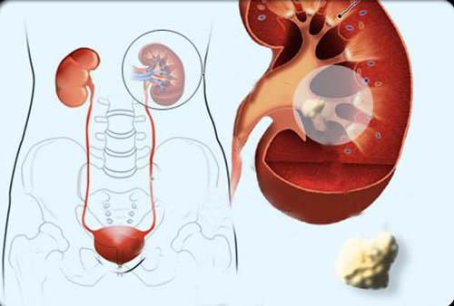 肾结石饮食注意事项 肾结石饮食要注意事项