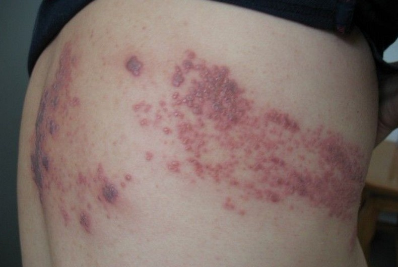 带状疱疹前期什么症状（带状疱疹 前期症状）