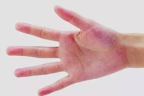 肝掌可以治愈吗 肝掌能自愈吗