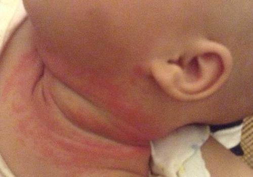 宝宝淹脖子破皮怎么办 小婴儿淹脖子破皮怎么办