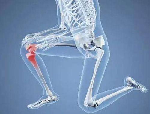 膝关节炎的症状表现 没症状预防是第一