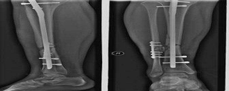 胫骨骨折一定要做手术吗（胫骨骨折能保守千万别手术）