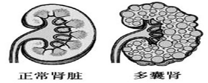 多囊肾怎么检测出来（多囊肾怎么能检查出来）