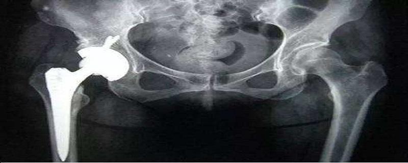 髋关节置换材料选择（髋关节置换最好的材料是什么）