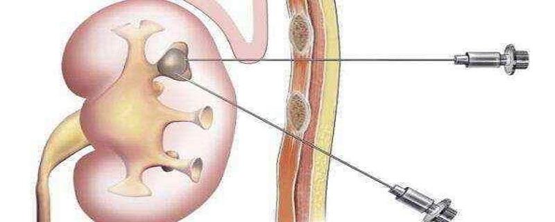 做肾穿刺有危险吗(肾穿刺对身体有危害吗)