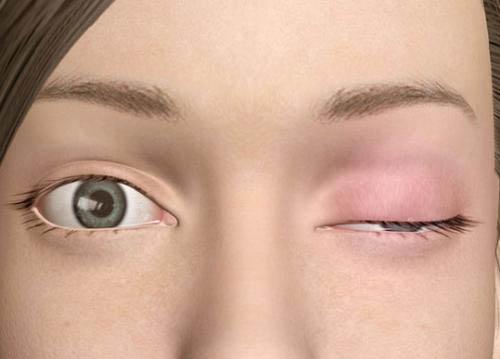 重症肌无力护理措施 重症肌无力日常护理