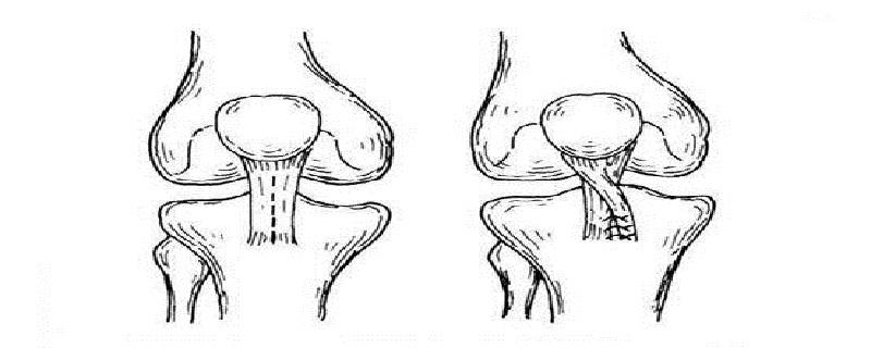 髌骨半脱位的原因 髌骨半脱位的原因有哪些