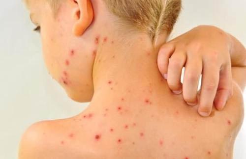 宝宝水痘症状(宝宝水痘症状初期)