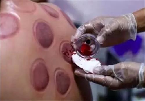 拔罐后黑紫是什么原因（拔罐后黑紫是什么原因呢）