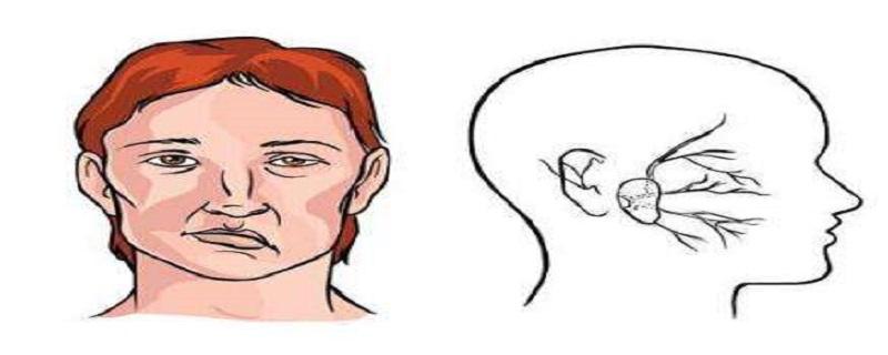 面神经麻痹疼痛怎么办 面神经麻痹疼痛怎么办吃什么药